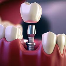 Dental Implants